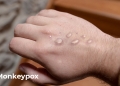 Monkeypox
