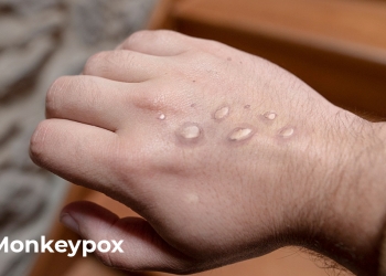 Monkeypox