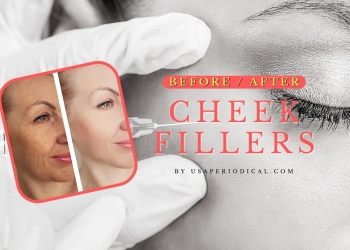 before and after cheek fillers