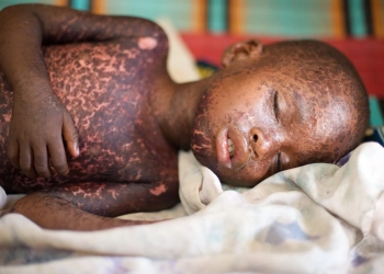WHO and CDC tagged measles as a global health threat