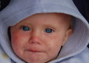 Ohio is Struggling With Measles Outbreak, Above 30 Kids Are hospitalized